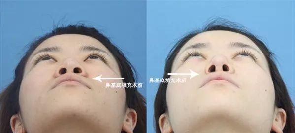 「小剂量浓注」肉毒素和玻尿酸的正确注射方法和解析(中面部篇)