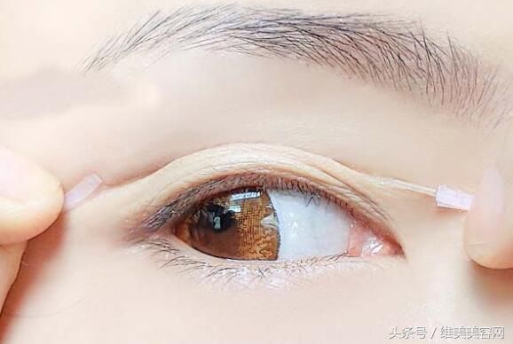 把单眼皮变成双眼皮，居然是这样做的
