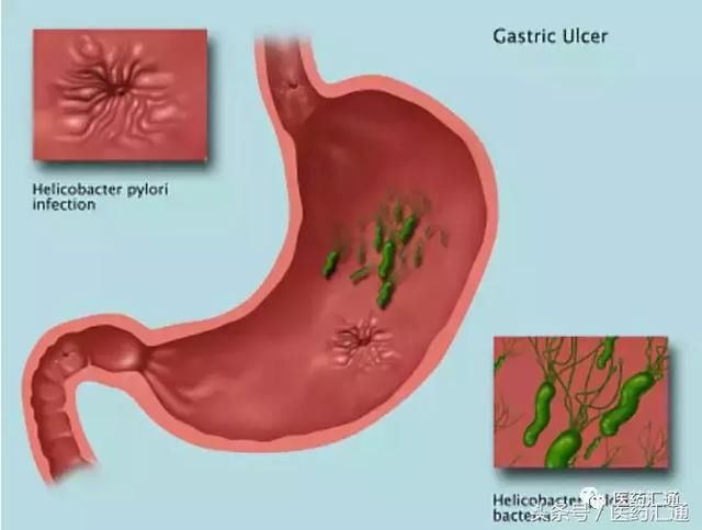 幽门螺旋杆菌难防、难治、易复发?看完这篇文