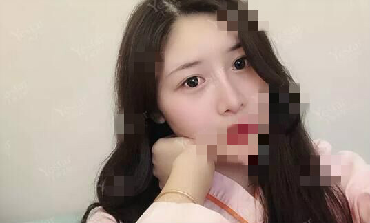 北京艺星割双眼皮确实是对的选择,气质好了