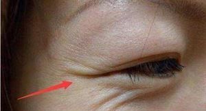 药房便宜的它，只需涂一点，七天美白祛皱，15天眼袋眼纹不见