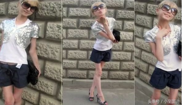 俄罗斯女子为减肥变成活骷髅，体重只剩42斤