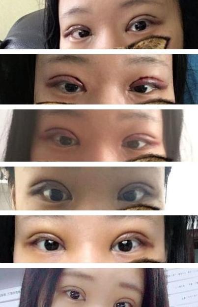 【美吧美啦案例】这逆天的颜值颠覆，竟只因一个双眼皮？！