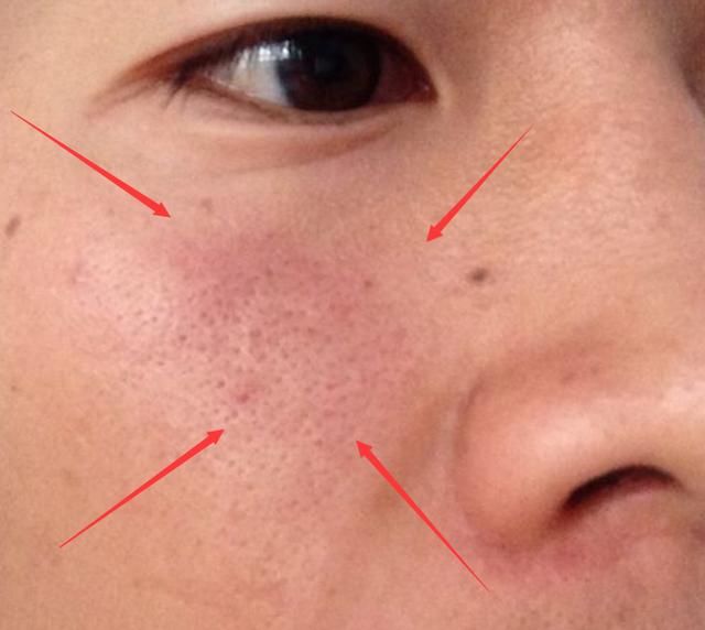 脸上有这4个表现，是螨虫发出的“最后警报”，别视若无睹