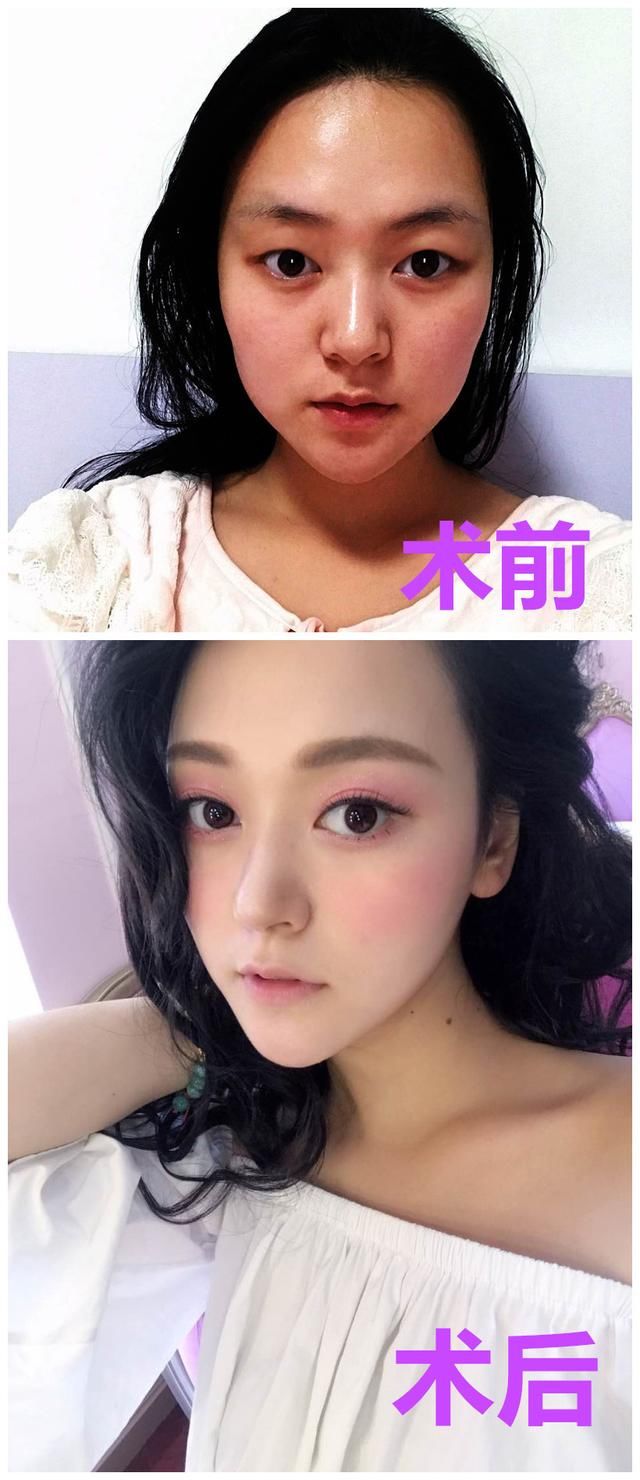 韩式双眼皮+开眼角能做出“桃花眼”吗？这篇真人案例值得参考！