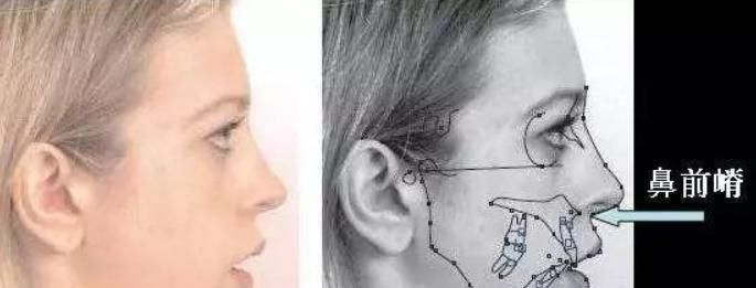  【影响】鼻基底凹陷畸形矫正临床策略及手术对面部表情的影响