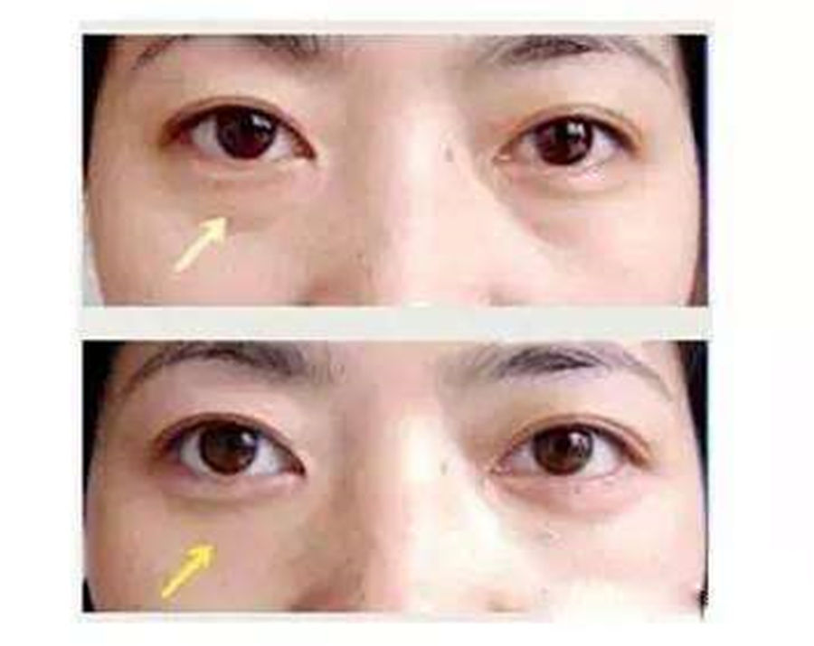 高龄皮肤主任告诉我:药店常见的药膏、用上3天，皱纹眼袋全消失