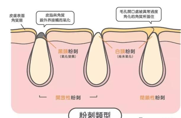说说:毛孔粗大怎么办口服ACMETEA28天搞定!