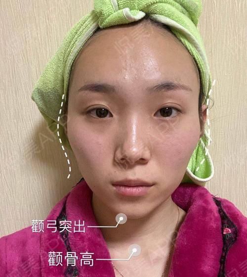  角度■我的下额角磨骨后形成第二个角度,这算不算磨骨失败?
