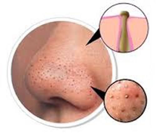 鼻子上为什么会有黑头？本文黑头图片高能警报，没做好准备勿看！