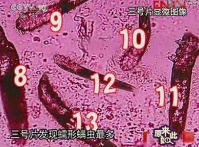 睡醒后出现4迹象, 不要怀疑, 说明毛孔已被螨虫堵得水泄不通