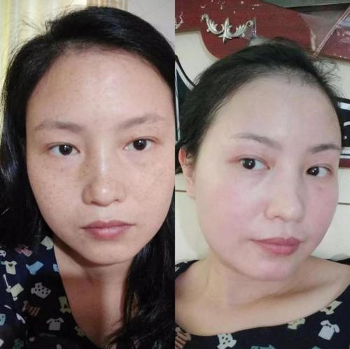 祛斑指日可下?医院主任一语道破:维生素E加它涂脸,一周两次送别黑