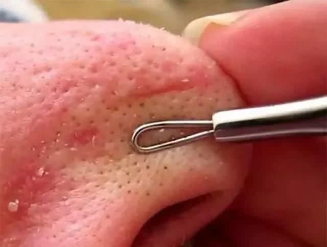 鼻子不断挤出“黄条物”，说明毛孔螨虫已破亿，教你2招能除螨