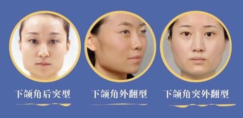  『术后』马上要去磨下颌角了，整理出了一份攻略