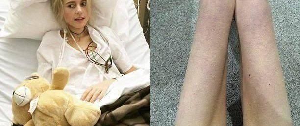 150斤女子因减肥患厌食症，体重剩下70斤，全身上下是骨头!