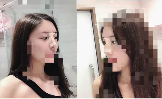 北京艺星割双眼皮确实是对的选择,气质好了