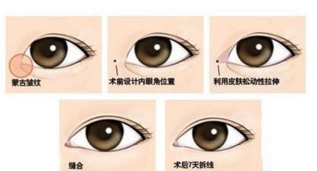  「内眦赘皮」割双眼皮一定要开眼角吗，可不可以割完双眼皮再考虑？