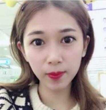 大眼睛美女做了双眼皮，男友说：恢复的挺不错的，越来越好看了