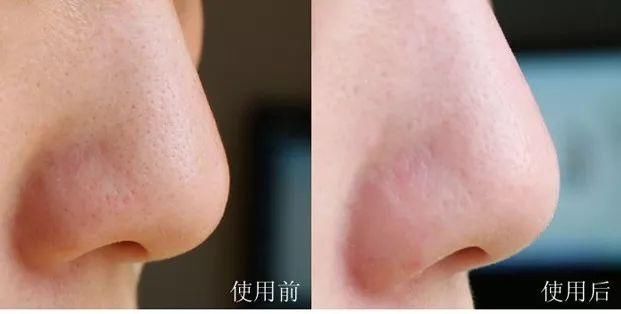 拔出黑头粉刺，地毯式清洁肌肤，还能缩小毛孔!素颜也自带妆容