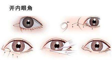 内眦赘皮:眼睛小怎么办?是开内眼角好还是开外眼角好?