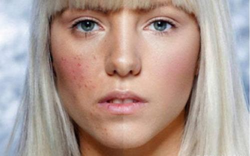 螨虫天天在脸上打洞,用这1招,脸蛋变得白白净净,开开心心等待开学