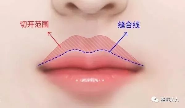  [好看]人中缩短术|你长得不好看，也许因为人中长！