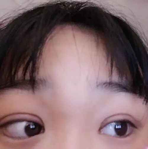 双眼皮一个月亲身经历，割对了双眼皮真的可以改变人生!