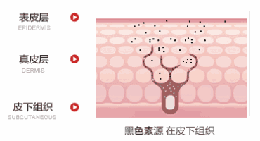  「黑色素」喝柠檬水祛斑美白？皮肤科专家说出“美白经”,赶紧学起来！