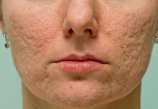 脸上发黄有痘痘？是螨虫在纠缠，每天需一法，螨虫轻松消失干净