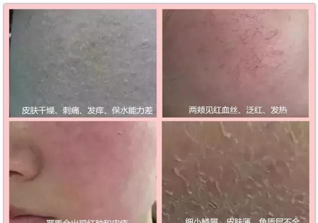  『过敏还』冬去春来，识别皮肤过敏源，皮肤“过敏”怎么急救？