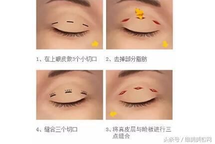 把单眼皮变成双眼皮，居然是这样做的