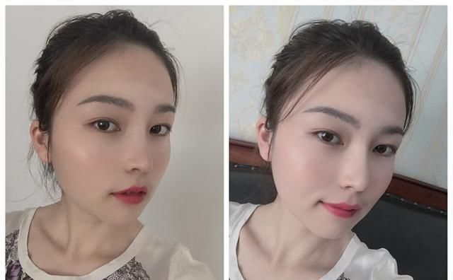  #术后#隆鼻真的有用吗？鼻综合术后六个月记录，这完全不是一个人！