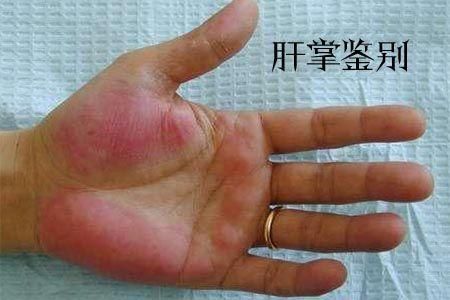 手掌出斑是肝癌吗，盘点7月出现了哪些谣言