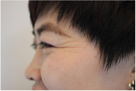 眼角皱纹多是什么原因 点此了解更多消息