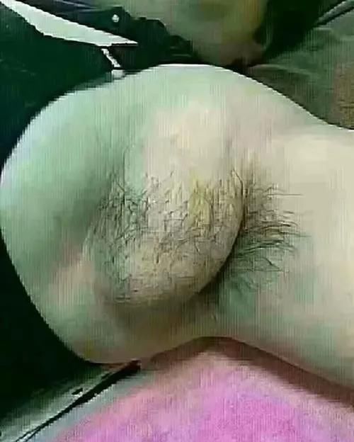  [腋窝]腋窝有包的女性要重视！那不是胖，这是淋巴堵塞