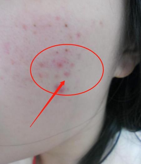 终算找到脸上螨虫的“死对头”了！学会3妙招，清空千万螨虫