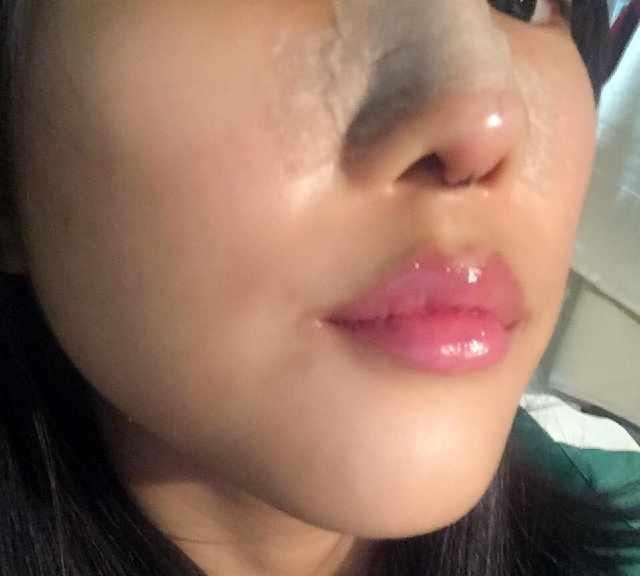  男友@小姐姐被男友带绿帽，分手后立马隆鼻，术后恢复让前任后悔莫及