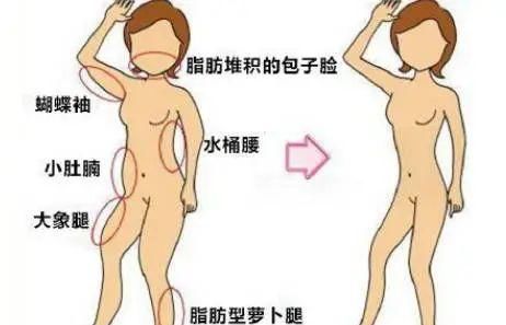 有用吗|吸脂减肥有用吗?《郑医说健康》专家传秘籍