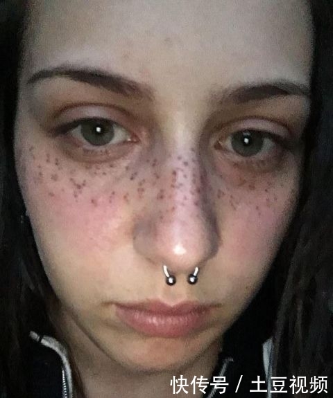  『手术』英女子痴迷梅根“雀斑妆”，拙劣手术让面部毁容，花3万治疗修复