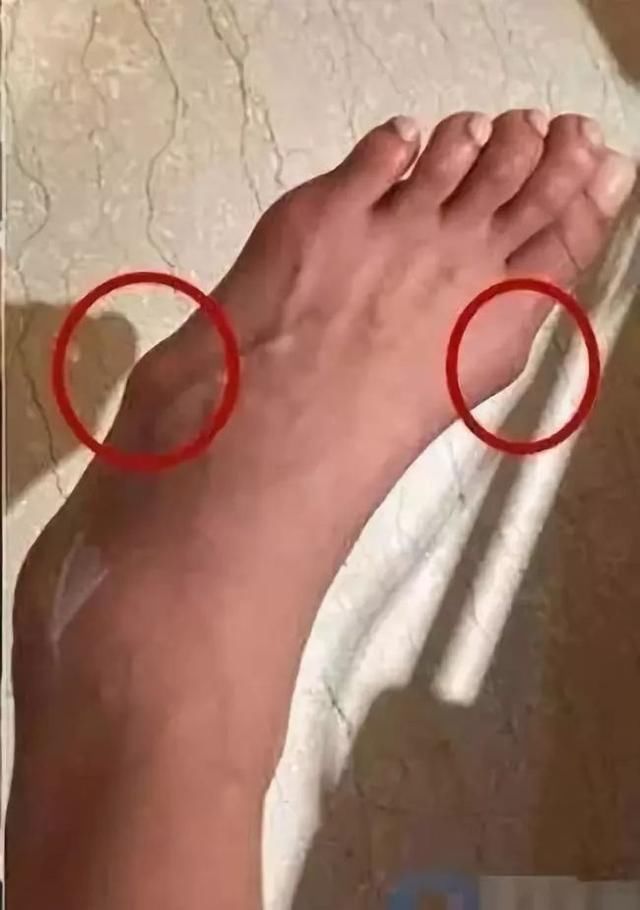 穿高跟鞋有多辛苦?冉莹颖脚被勒出印，她的脚趾变形