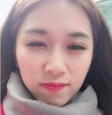 大眼睛美女做了双眼皮，男友说：恢复的挺不错的，越来越好看了