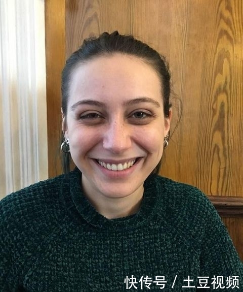  『手术』英女子痴迷梅根“雀斑妆”，拙劣手术让面部毁容，花3万治疗修复