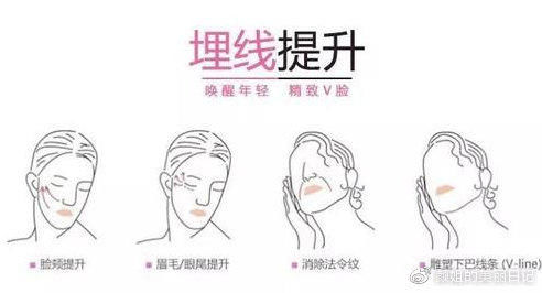  症状：埋线提升恢复期有什么症状吗？