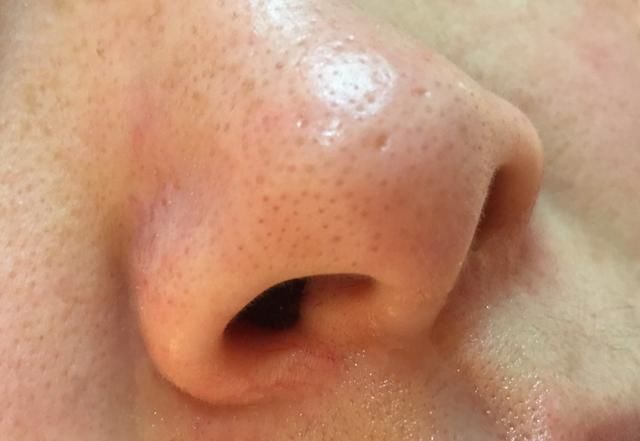 脸上有这4个表现，是螨虫发出的“最后警报”，别视若无睹