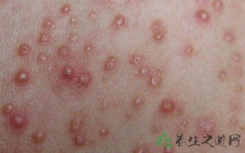 艾滋长得痘痘会痒吗 雪花新闻