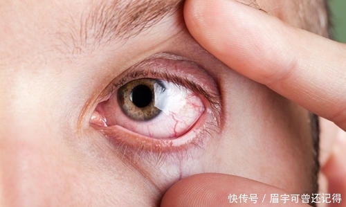  眼皮■眼皮下垂怎么自然恢复?眼皮为什么会下垂？