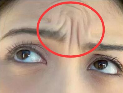 女人有抬头纹无需打玻尿酸，瞧瞧下图女人，药膏抹一抹，纹乖乖走