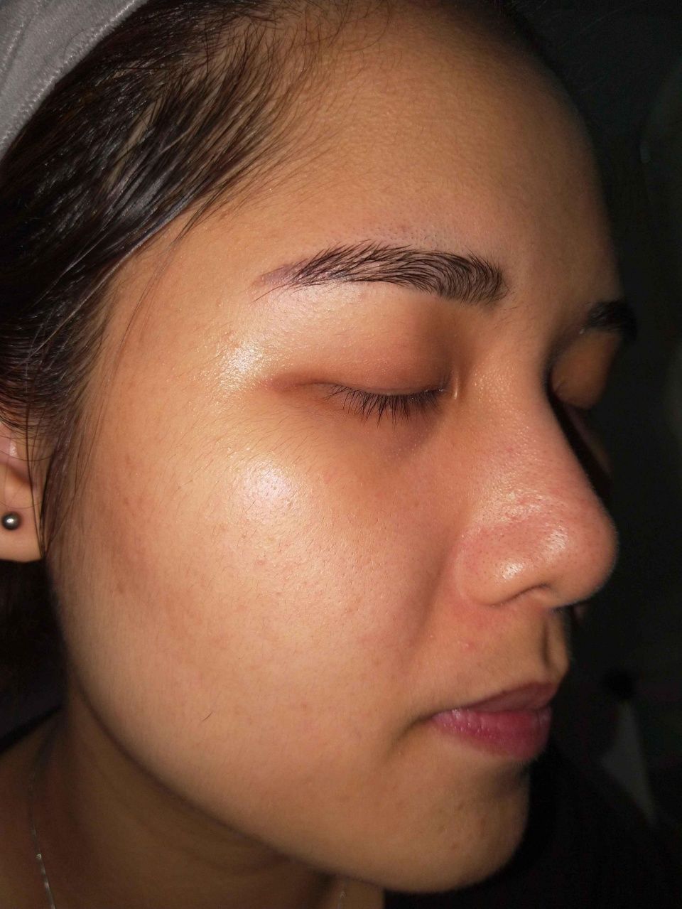 如何去除“闭口粉刺”