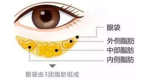  「相关」眼部美容之眼袋相关问题详解