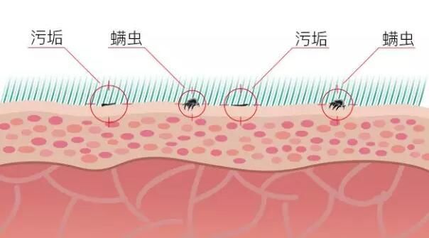 脸上爱长“白色颗粒”，说明上万螨虫挖开毛孔，简单去除只需3招